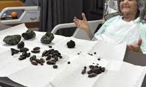 Turquie : 35 olives, 28 noyaux de dattes et 5 pierres extraits du ventre d’une nonagénaire